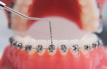 How-Do-Braces-Work-Southern-Orthodontic-Specialists-Collierville-Southaven.webp