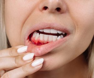 ulcerative-stomatitis-gums-gum-inflammation-woman-showing-red-bleeding-gingiva-with-ulcer-scaled.jpg